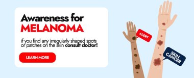 Melanoma Deri Hastalığı. Cilt kanseri farkındalığı, iki farklı etnik elin Melanoma kanseri lekeleri ile örtülmüş. Deri enfeksiyonu hastaları için sosyal medya pankartı. Melanoma uyarı işaretleri.