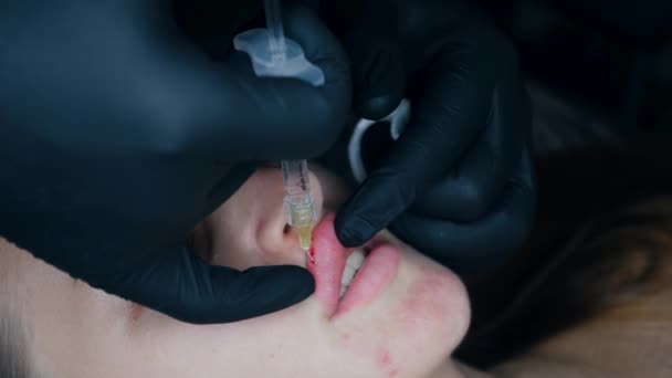 扩大唇的程序 女性唇 男外科医生用注射器小心地 慢慢地将透明质酸注入妇女的嘴唇 注射美容品整形手术 — 图库视频影像