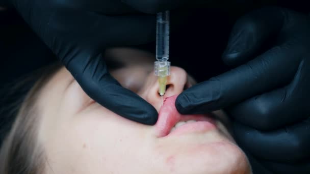 Procedimiento Aumento Labios Primer Plano Labios Femeninos Cirujano Masculino Inyeccionista — Vídeos de Stock
