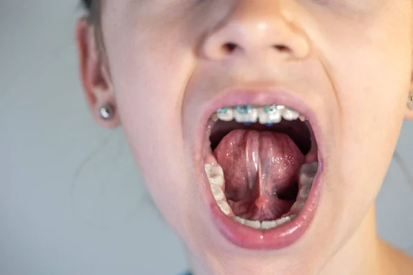 Uma Criança Abre Boca Mostra Seu Salão Conceito Odontologia Ortodontia — Fotografia de Stock