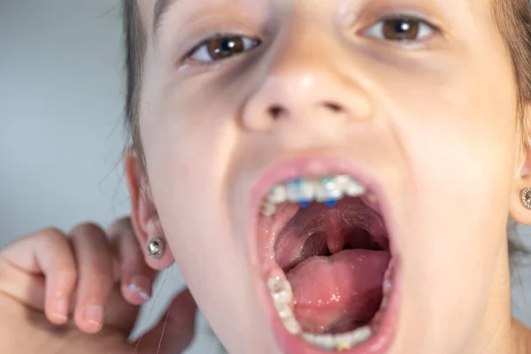 stock image A child girl open her mouth and show her tounge, the concept of dentistry, orthodontics.