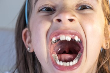 Little happy kid girl at dentist office smiling showing overbite teeth, child during orthodontist visit and oral cavity check-up, children tooth care and hygiene. clipart