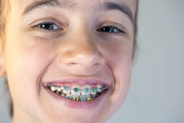 Adolescente Avec Des Bretelles Sur Les Dents Gros Plan Sourire — Photo