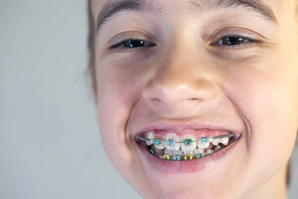 Tonårstjej Med Tandställning Tänderna Närbild Ett Leende Perfekt Leende Koncept — Stockfoto