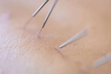 Dry needling acupuncture needles used by acupuncturist physiotherapist on patient in pain and injury treatment, close up macro photo. clipart