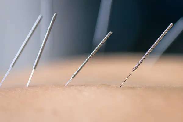 Agulhas Acupuntura Agulhas Secas Usadas Pelo Fisioterapeuta Acupunturista Paciente Tratamento — Fotografia de Stock