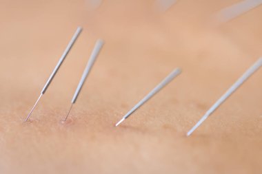 Akupunkturcu fizyoterapistin hastaya acı ve yaralanma tedavisinde kullandığı kuru iğneli akupunktur iğneleri..