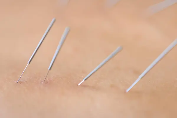 Dry needling acupuncture needles used by acupuncturist physiotherapist on patient in pain and injury treatment, close up macro photo.