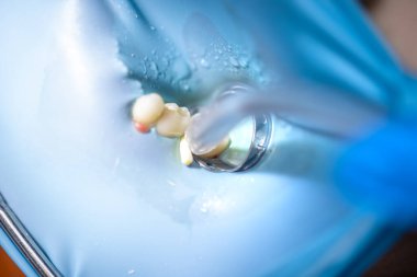 Dişçi kauçuk baraj kullanarak çocuğun dişini tedavi ediyor. Diş tedavisine yakın çekim. Yüksek kalite fotoğraf. Dişçi muayenehanesi. Dişçi konsepti. Dişe kauçuk baraj takmak.