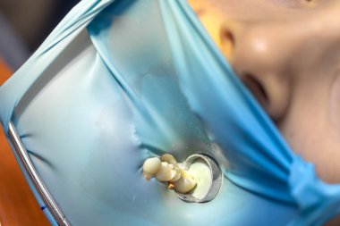 Dişçi kauçuk baraj kullanarak çocuğun dişini tedavi ediyor. Diş tedavisine yakın çekim. Yüksek kalite fotoğraf. Dişçi muayenehanesi. Dişçi konsepti. Dişe kauçuk baraj takmak.