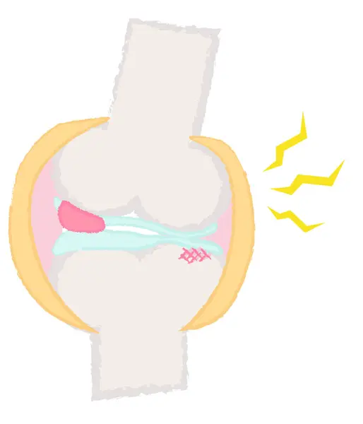 Elle çizilmiş eklem ve kemik örnekleri: Dizdeki kemik iltihabı