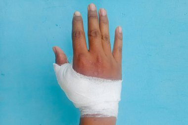 Sağ el bandajı. Erkek, mavi arkaplan.