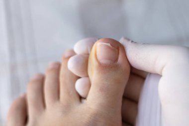 Kırık ve yaralanmış ayak başparmağının tırnağı ve beyaz eldiveni yakın plan, sağlık konsepti, pedikür