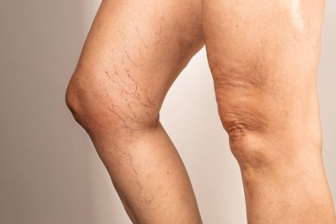 İnsan bacağında varisli damarlar ve görünür kılcal damarlar görünüyor. Cilt hafif kırışık ve düzensiz görünüyor. Damar sorunlarını vurguluyor..