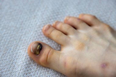 Toe injury in a child with a traumatised toenail . High quality photo clipart