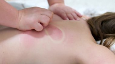 Lastik kutularla masaj. Soğuk algınlığı için masaj masajı masajdan sonra kırmızı halkalar. Kırmızı sırt, evde pembe lastik kutuyla masaj yapan genç bir kızın korkunç görüntüsü.