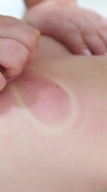 Lastik kutularla masaj. Soğuk algınlığı için masaj masajı masajdan sonra kırmızı halkalar. Kırmızı sırt, evde pembe lastik kutuyla masaj yapan genç bir kızın korkunç görüntüsü.