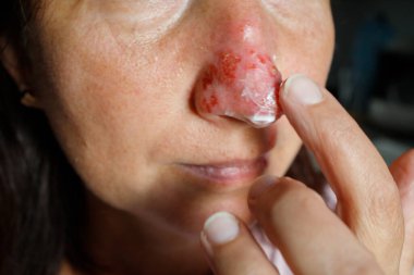 Burnuna şifalı uçuk merhemi süren bir kadın.