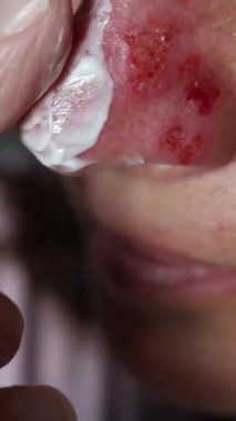 Burnuna uçuk bulaştıran bir kadın tedavi merhemi sürmüş.