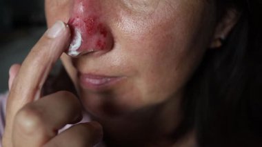 Burnuna şifalı merhem sürmüş bir kadın.