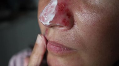 Burnuna dermatolojik sorunlarla iyileşen uçuk merhemi süren bir kadın.