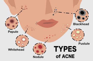 Yüz Akne Tipleri İllüstrasyonu, Cilt Eğitimi, Dermatolog Referansı, Tıbbi Bilgiler