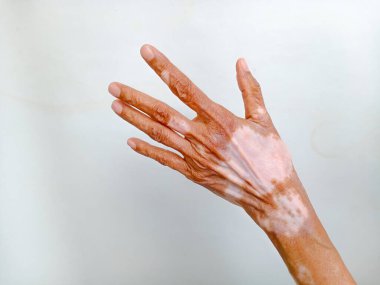 Cilt sorunu olan Asyalı yaşlı kadın eli vitiligodur. Beyaz arka planda vitiligo derisi pigmentasyonu olan Asyalı El