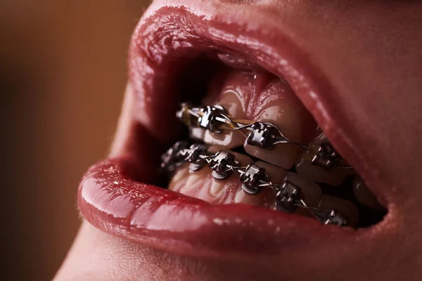 Close-up of a woman\'s mouth with braces on her teeth