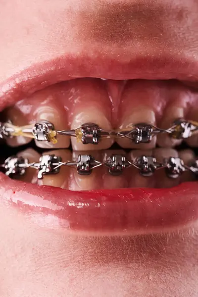 彼女の歯に勇敢な女性の口のクローズアップ — ストック写真