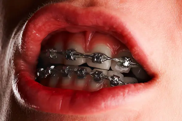 Close-up of a woman\'s mouth with braces on her teeth