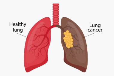 Sağlıklı akciğer ve akciğer kanseri