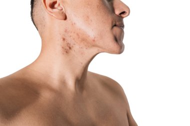Beyaz bir geçmişi olan bir adamın yüzünde kistik ve hormonal sivilceler.