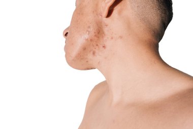 Beyaz bir geçmişi olan bir adamın yüzünde kistik ve hormonal sivilceler.