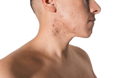 Beyaz bir geçmişi olan bir adamın yüzünde kistik ve hormonal sivilceler.
