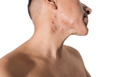 Beyaz bir geçmişi olan bir adamın yüzünde kistik ve hormonal sivilceler.