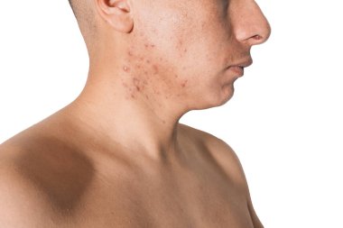 Beyaz bir geçmişi olan bir adamın yüzünde kistik ve hormonal sivilceler.