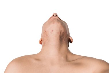 Beyaz bir geçmişi olan bir adamın yüzünde kistik ve hormonal sivilceler.