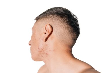 Beyaz bir geçmişi olan bir adamın yüzünde kistik ve hormonal sivilceler.