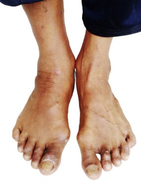 Bir çift şişmiş ayak, muhtemelen tıbbi bir durumun göstergesi. Beyaz Arkaplanda İzole Edilmiş