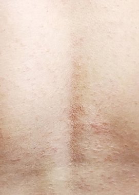 Herpes Zoster Rash (Kiremit) deride sıvı dolu kabarcıklar gibidir..