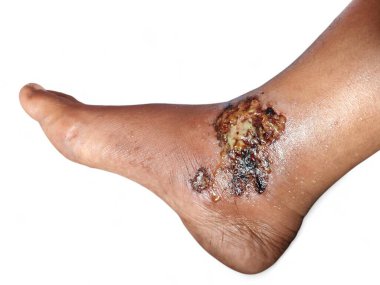 Derisinde sıyrıklar olan bir adamın ayağını kapat. Sağlık, yaralı ayak, ayak bileğinde sıyrıklar ve kızarıklık var.