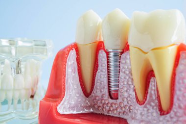 Çene içine yapay diş kökleri diş implantı, diş hekimi için kök kanal modeli.