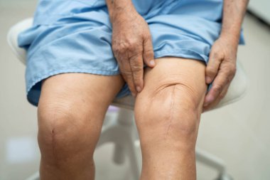 Asyalı yaşlı kadın hasta yaralarını gösteriyor. Diz eklemi ameliyatı. Yara eklemi artroplasti..