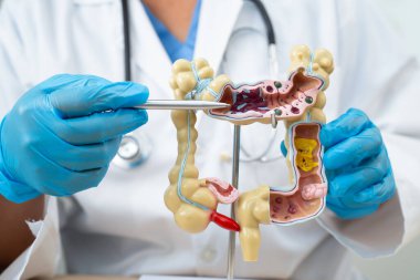 Ülseratif Kolit. Bağırsak, apandis ve sindirim sistemi, hastanede teşhis ve tedavi için anatomi modelini tutan doktor..