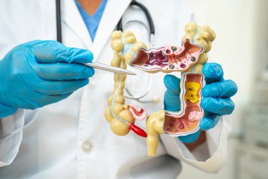 Ülseratif Kolit. Bağırsak, apandis ve sindirim sistemi, hastanede teşhis ve tedavi için anatomi modelini tutan doktor..