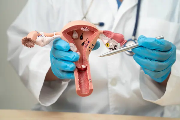 stock image Uterus, doctor with anatomy model for study diagnosis and treatment in hospital.