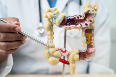 Ülseratif Kolit. Bağırsak, apandis ve sindirim sistemi, hastanede teşhis ve tedavi için anatomi modelini tutan doktor..