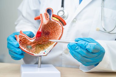 Dispsi ya da mide hastalığı, hastanede teşhis ve tedavi için mide anatomisi modeli tutan doktor..