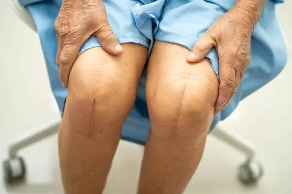 stock image Asian elderly woman patient show her scars surgical total knee joint replacement Suture wound surgery arthroplasty.