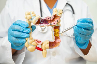 Ülseratif Kolit. Bağırsak, apandis ve sindirim sistemi, hastanede teşhis ve tedavi için anatomi modelini tutan doktor..